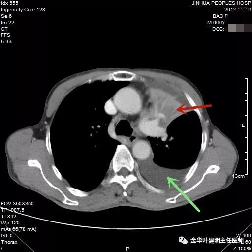 肺癌伴胸腔积液伴膨胀不全,肺癌晚期转移到肝脏引起腹腔积液