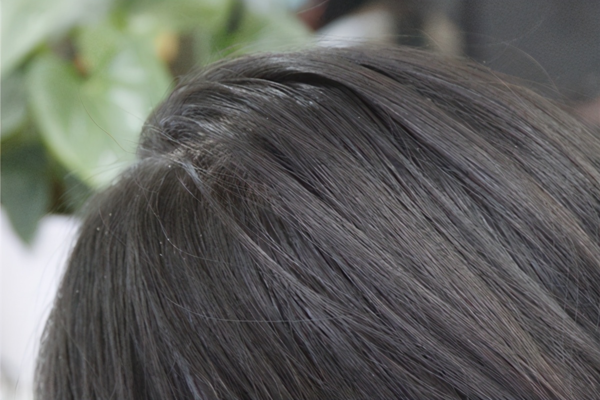 头皮屑是从哪里来的,干性头皮屑和脂溢性皮屑