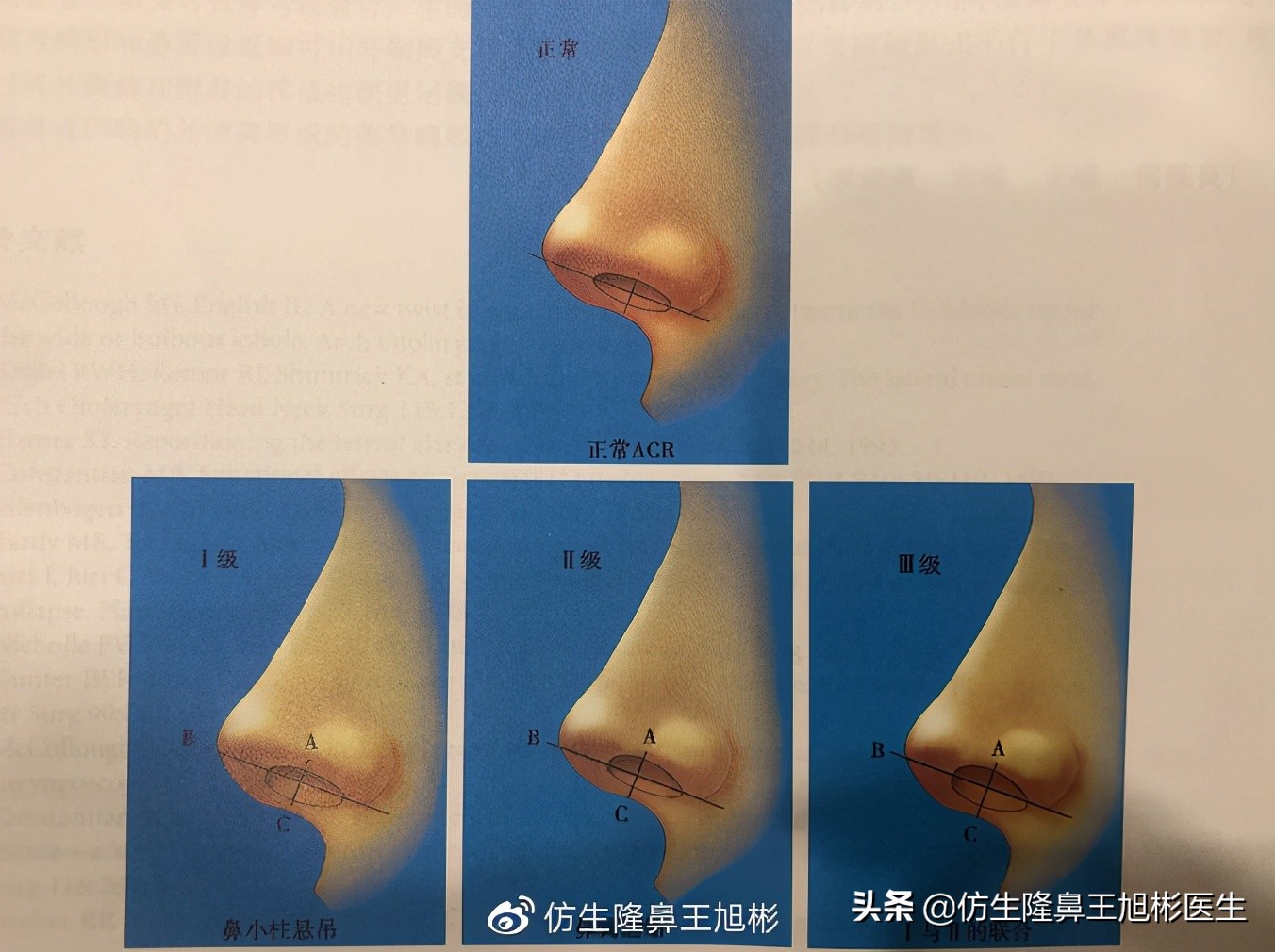 鼻翼缘畏缩要如何矫正|王旭彬隆鼻