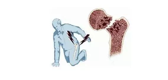 87岁老人髋关节摔骨折了怎么治疗,80岁老人胯骨摔骨折怎么恢复