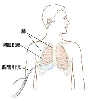 为什么手术后要系腹带,为什么手术后要戴根管