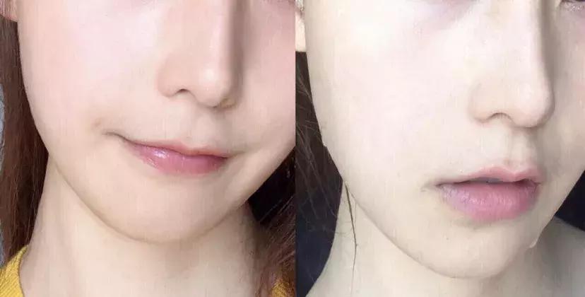 日本的美白针,日本最强美白针