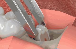 为什么拔智齿那么疼,为什么拔智齿会痛这么久