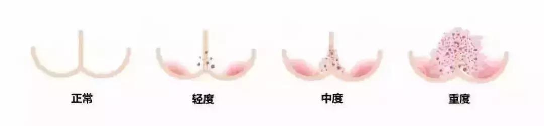 宝宝为什么会红屁股该怎么解决,宝宝总是红屁股怎么办