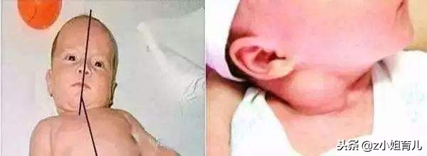 别再这样抱宝宝了，会歪脖子你还不知道吧，分享下如何纠正歪脖子