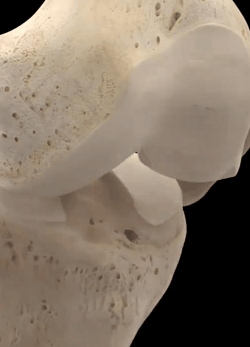 膝关节骨关节炎怎样手术能治好,膝关节镜能治好关节炎吗