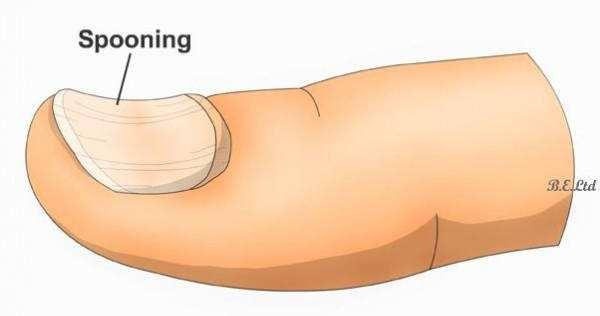 指甲呈勺状是什么原因,指甲出现反甲的图片