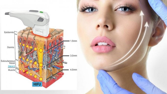 什么是热玛吉除皱术千万别入坑,什么是热玛吉整形项目