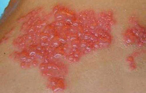 治疗带状疱疹用哪几种药配合最好,带状疱疹治疗方法及用药关注事项