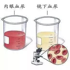 尿液呈红色就是血尿呢？真正的血尿要这样来区分