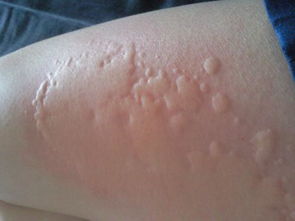 小心盆栽：女子白癜风恶化，表妹送的乔迁礼成罪魁祸首