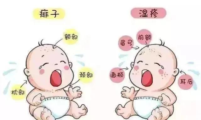 小孩子得湿疹用什么药膏没有激素,小孩湿疹抹了激素药膏皮肤白一块