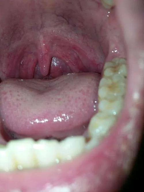 急性咽喉炎吃慢性咽炎的药有用吗,慢性咽炎怎么治才能除根吃什么药