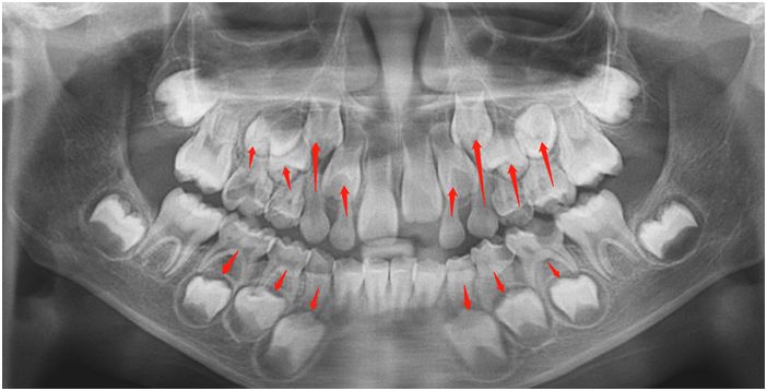 孩子的乳牙要掉了可以拔吗,小孩的乳牙真的可以治疾病吗