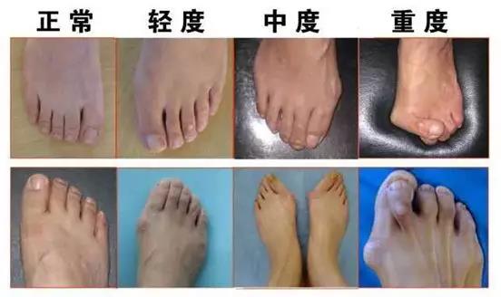 什么叫做拇外翻,什么是拇骨外翻