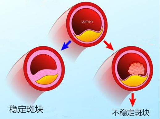 心脑血管病有斑块怎么办,心脑血管病有斑块怎么治疗
