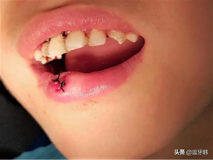 骑车摔伤牙齿松动怎么办,牙齿摔伤会引起发烧吗