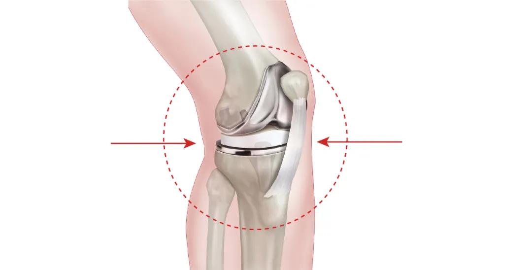 单髁膝关节置换手术后康复,膝关节置换术前关注事项主任讲解