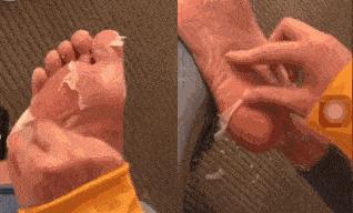 科普微针祛痘,消炎修复和祛痘