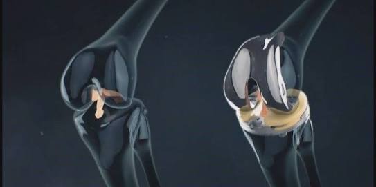 关节炎辟谣,膝关节滑膜炎辟谣