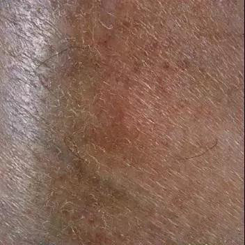 秋冬皮肤瘙痒怎么解决,换季皮肤痒是什么皮炎