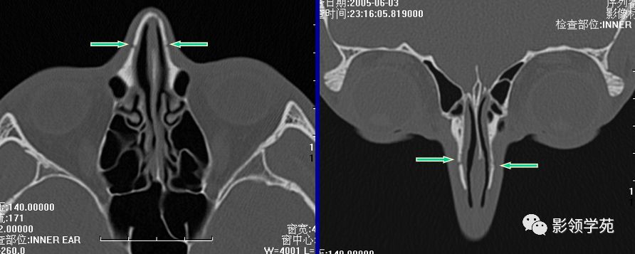 鼻骨骨折的检查方法,鼻骨骨折影像学表现