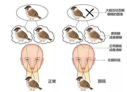 孩子弱视严重又要上学怎么训练,孩子斜视弱视的最佳解决方法