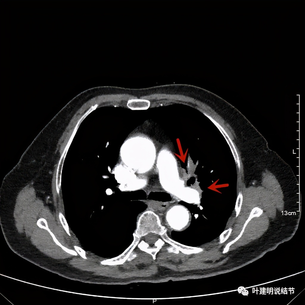 卡瑞利珠单抗治疗肺鳞癌有用吗,特瑞普利单抗对鳞癌治疗有效吗