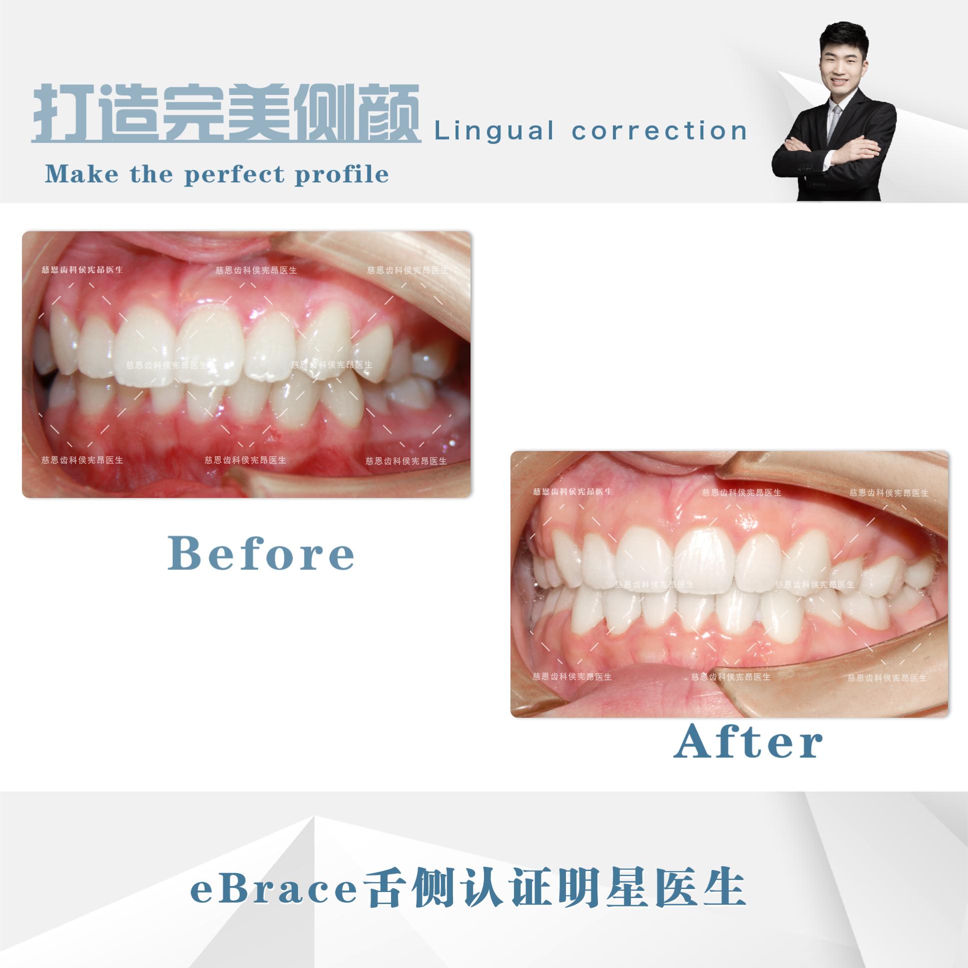 牙突怎么矫正,怎么矫正嘴突