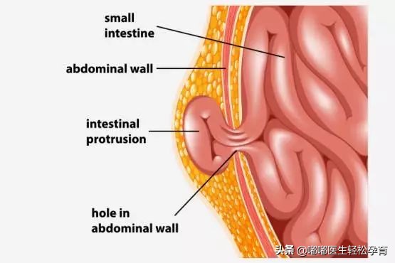 无知父母帮孩子放气,无知的父母不知道小儿脐疝