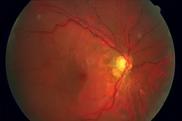 高度近视遗传可以恢复吗,高度近视遗传能干预吗