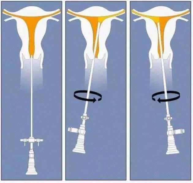 宫腔镜电切刀是什么样子,宫腔镜下正常的宫腔是什么样子