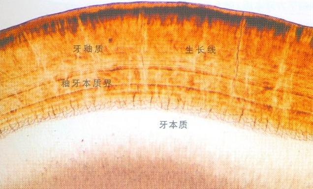 牙釉质受损能自己修复吗,牙釉质损坏有什么补救的吗