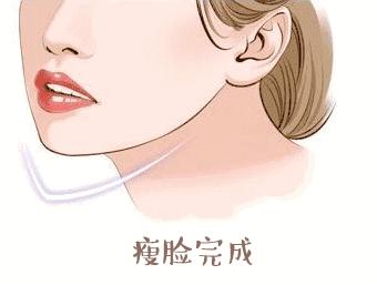 瘦脸针小v脸几天见效果,瘦脸针打完后几天出效果