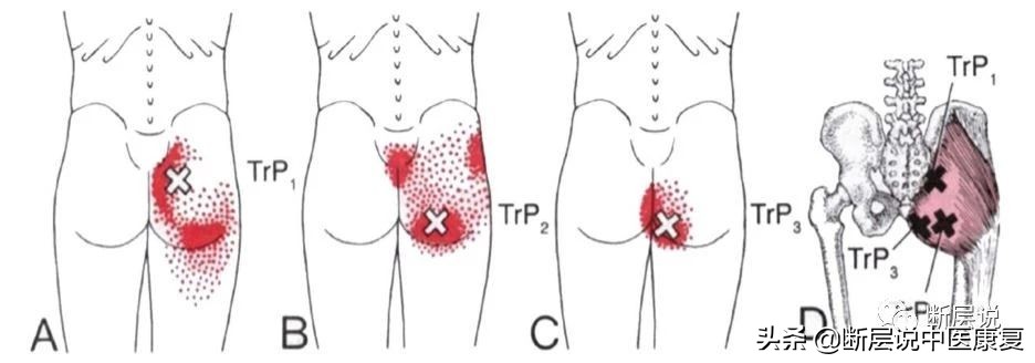 怎么缓解腰引起的臀部疼痛,怎样治疗腰痛和臀部肌肉疼痛