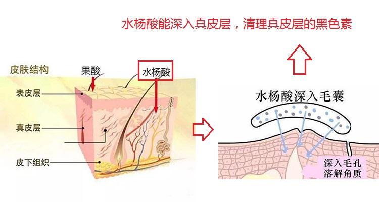 黑色痘印怎么能彻底消除,黑色痘印怎么消除小妙招视频