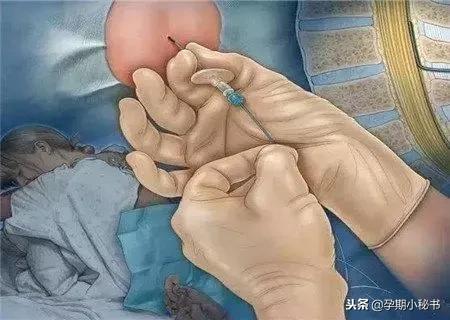 顺产生孩子剖腹产的真实流程,顺产剖腹产生孩子的真实流程