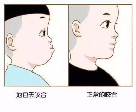 小朋友牙齿地包天矫正方法,牙齿地包天多大矫正最合适