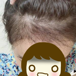 发际线太高怎么办,发际线太高怎么办做什么发型