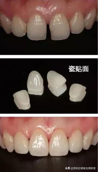 牙缝大吃东西总塞怎么办,牙缝太大了吃东西老是塞住怎么办