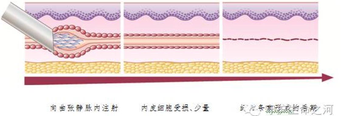 隔壁老王说静脉曲张可以打针治疗！这是真的吗？