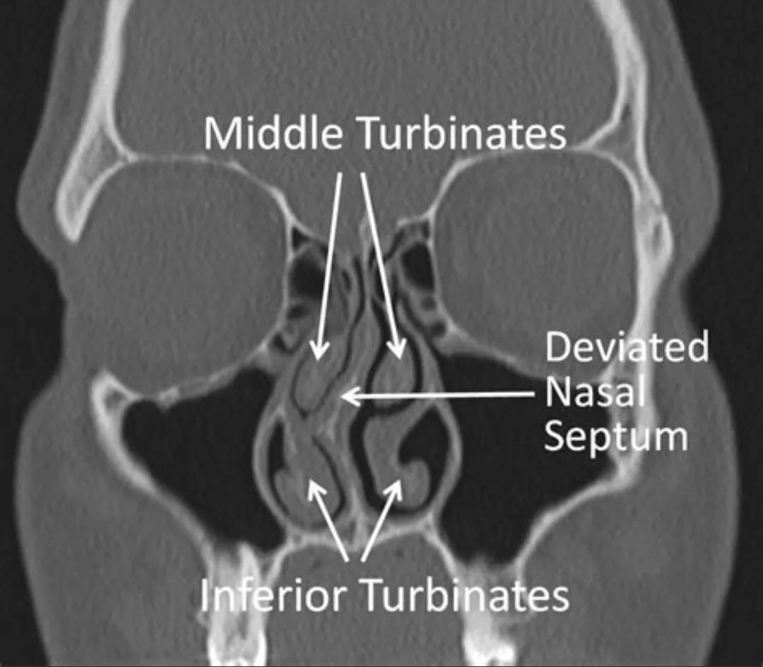 嗅觉障碍是什么感觉,嗅觉障碍怎么解决
