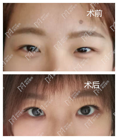 发现小孩大小眼越来越明显,小女孩大小眼怎么回事