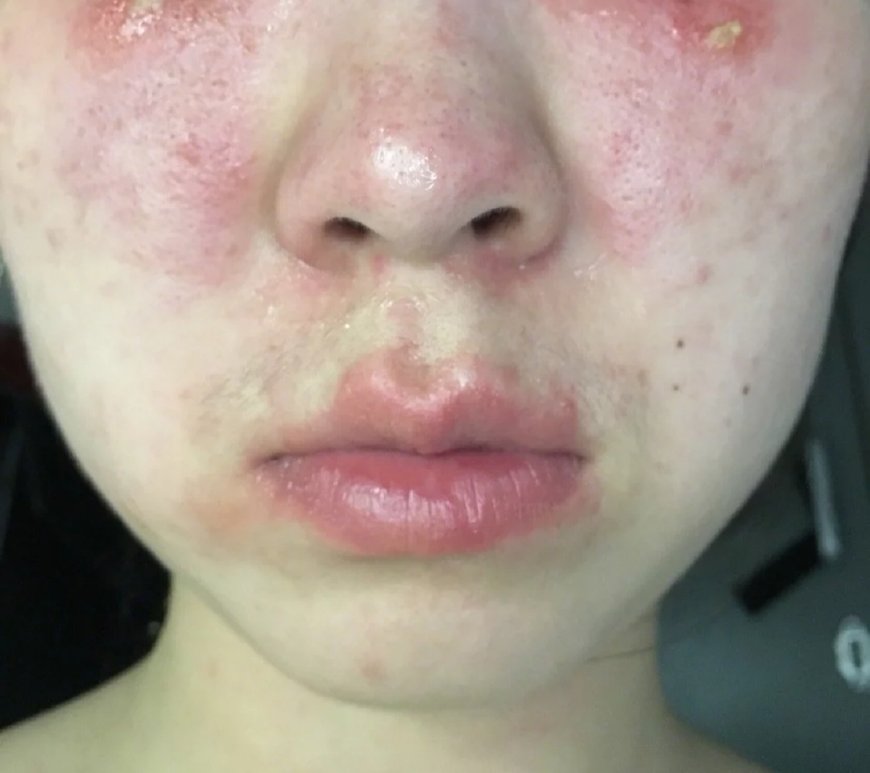 敏感肌兰蔻推荐,干皮护肤品推荐兰蔻粉水辣脸