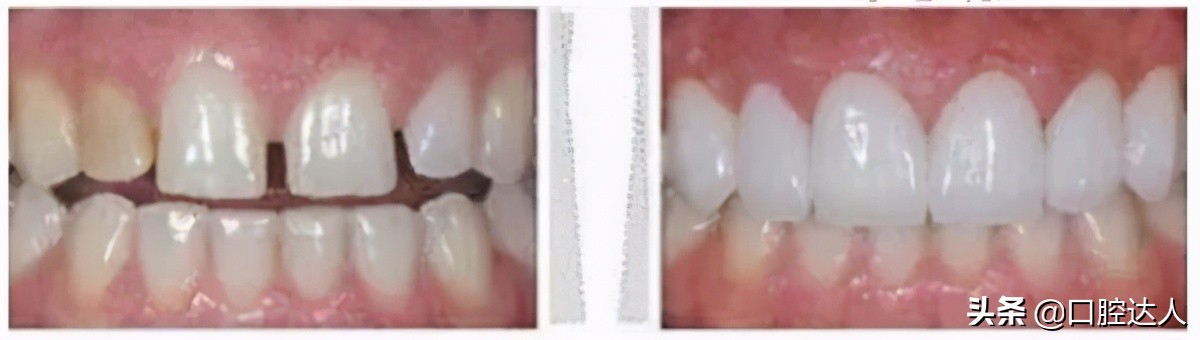 贴面矫正牙缝,全瓷贴面补牙缝多少钱