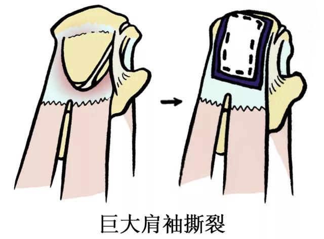 肩伤如何练肩,骨科专家教你肩袖康复训练