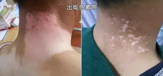 308光疗治疗白癜风副作用,308白癜风光疗后掉皮正常吗