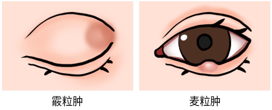 宝宝眼睛长了个麦粒肿,帮孩子规避风险是好是坏