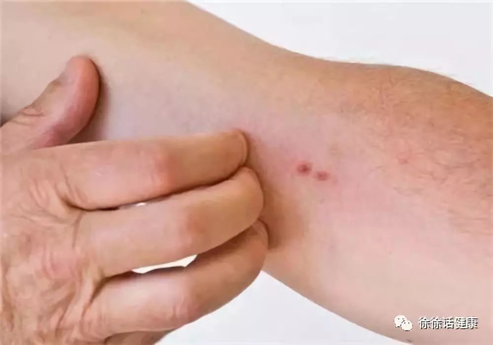 湿寒引起皮肤瘙痒,血虚湿蕴型皮肤瘙痒症