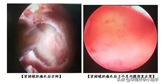 子宫肌瘤是咋把胎儿挤丢的？流产和不孕都是谁的错？备孕必读